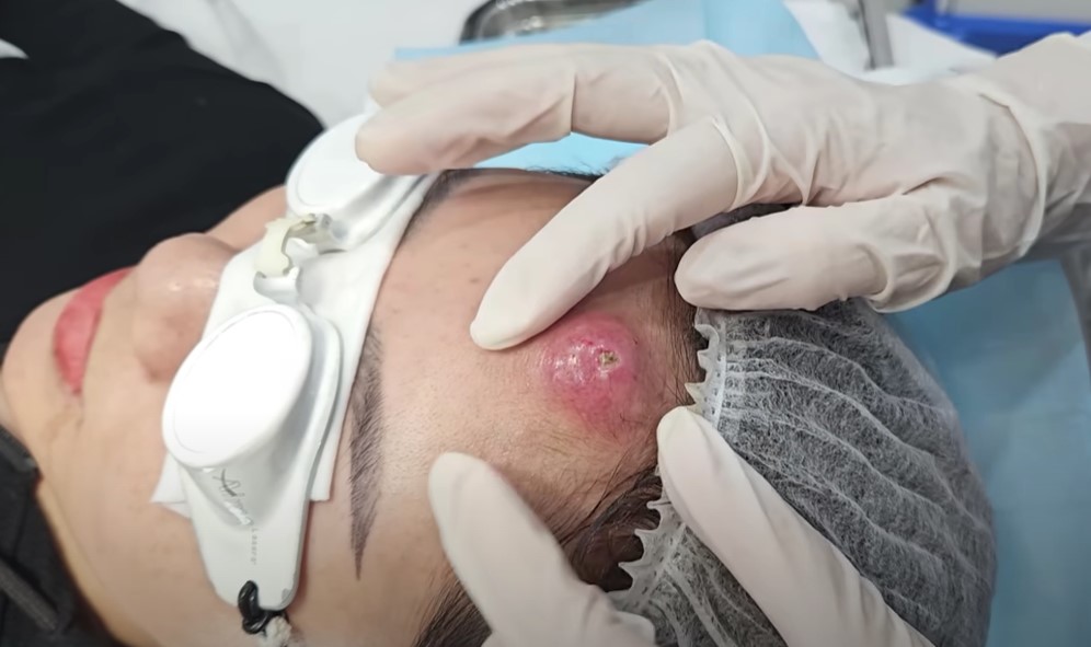 That’s the most beautiful/ disgusting extraction I’ve seen in awhile WOW- Dr Sandra Lee