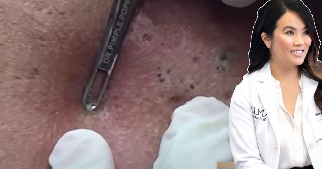 Blackhead Field of Dreams: Supercomedones & Dilated Pores of Winer