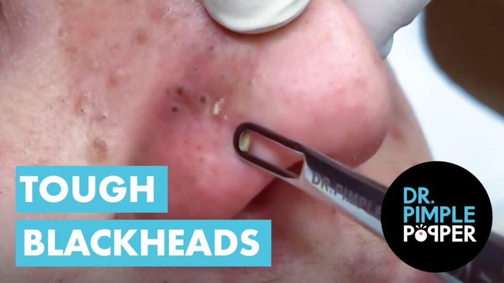 Dr Pimple Popper vs Tough Blackheads br Dr Sandra Lee