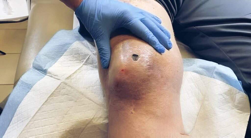 Drainage of a knee hematoma