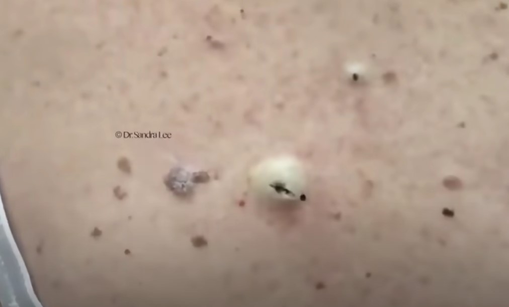 Dr Pimple Popper vs THE BIG ONE