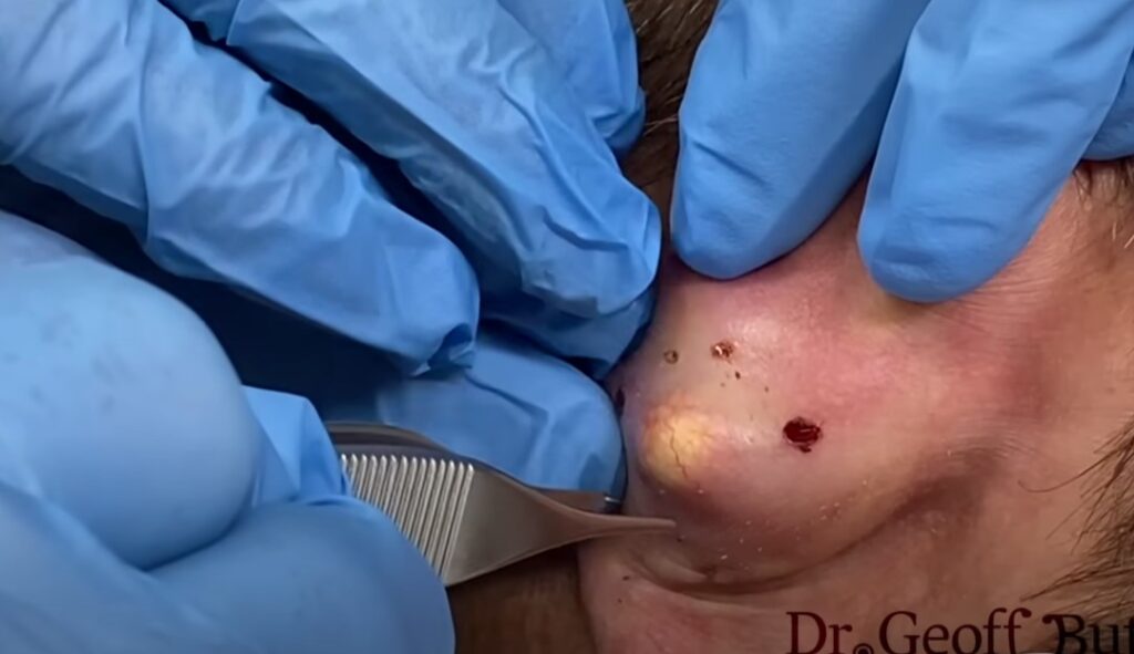 Removal of epidermal cyst on the ear