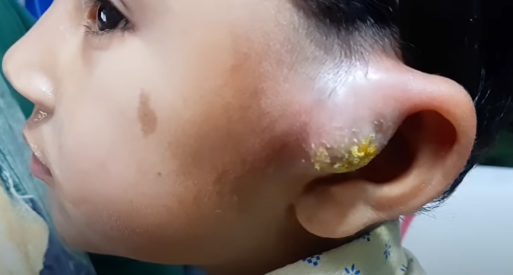 Massive abscess near left ear || pus expulsion || preauricular sinus infection || 👍👍🙏